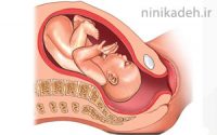 چرخیدن جنین در شکم مادر